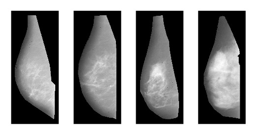 breast cancer density